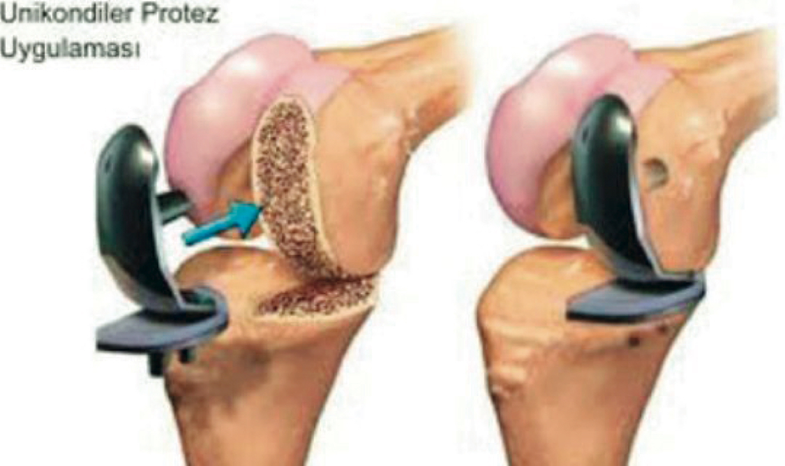 Операция по замене коленного сустава москва. Коленный эндопротез Stryker. Genesis 11ps эндопротез коленного сустава. Эндопротез коленного сустава Stryker. Частичное эндопротезирование коленного.